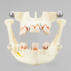 Implantat Studiemodel 